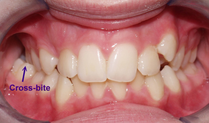 At what age can kids get braces