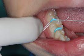 Inserting and removing spacers process