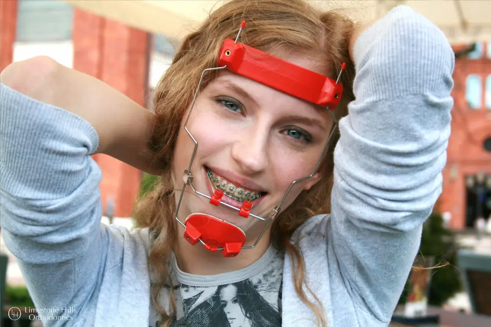 a woman smiling with red reverse pull headgear braces on her face from Limestone Hills Orthodontics in Austin, TX