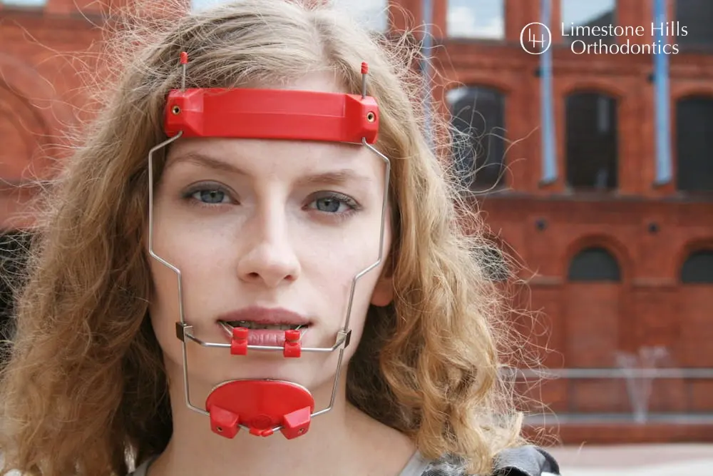 a woman smiling with red reverse pull headgear braces on her face in Austin, TX