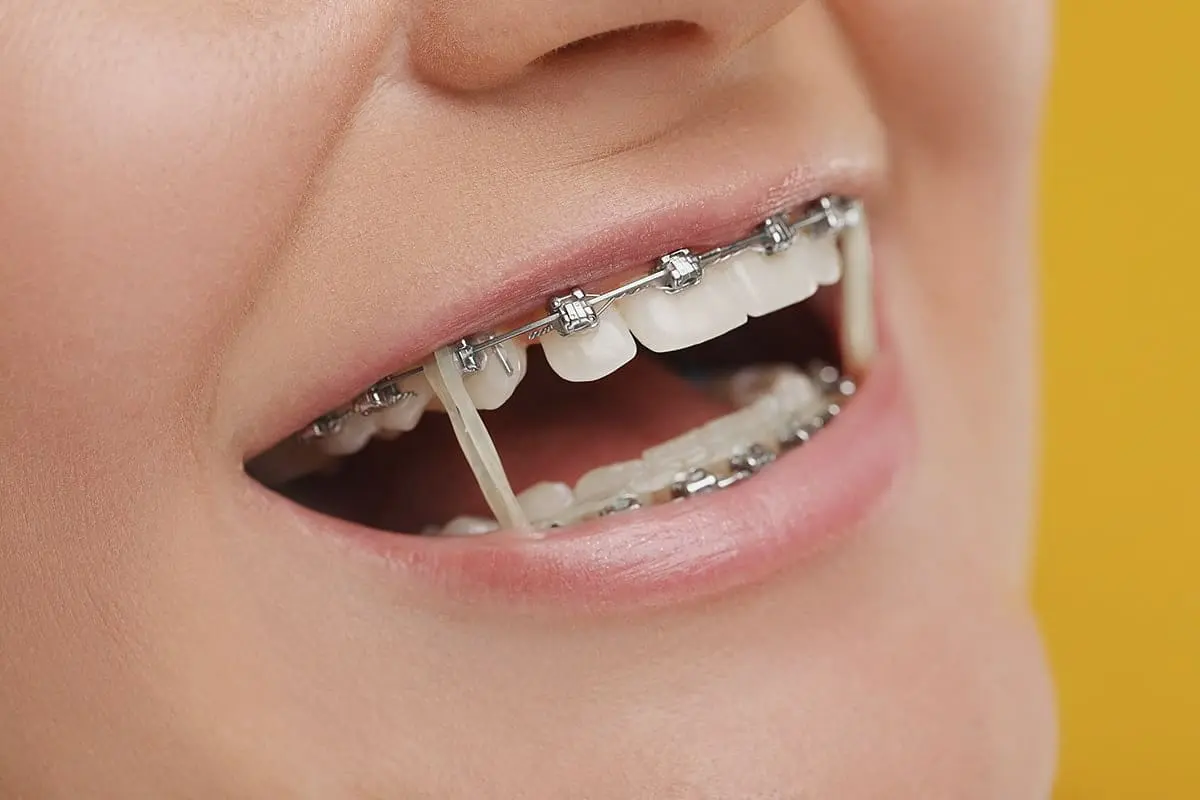 Consequences of Not Wearing Orthodontic Elastics
