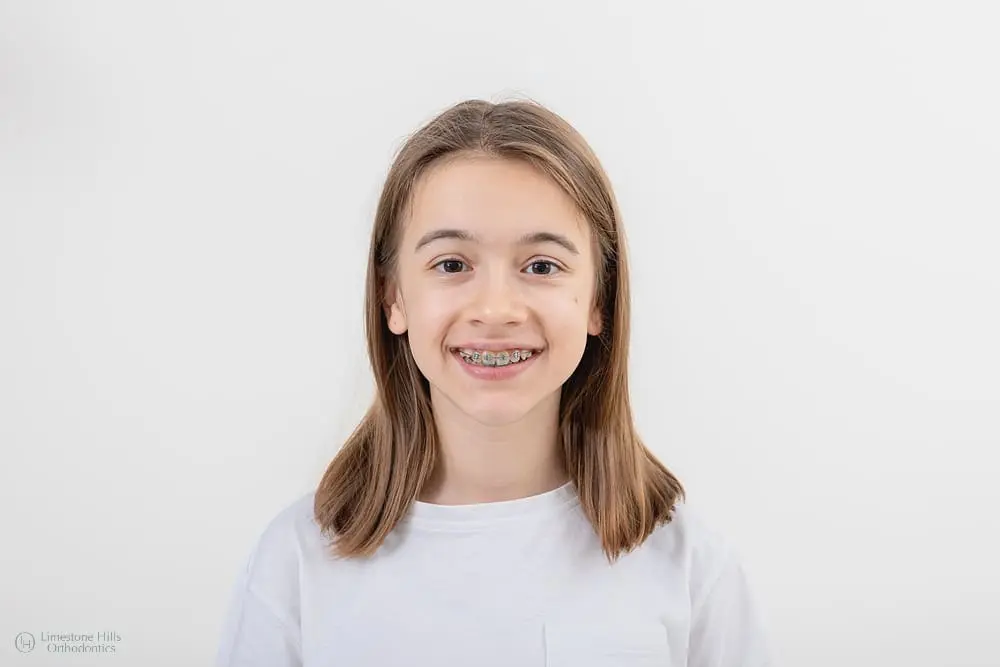 Smiling with braces, a child poses in a white shirt; Limestone Hills Orthodontics in Austin, TX.