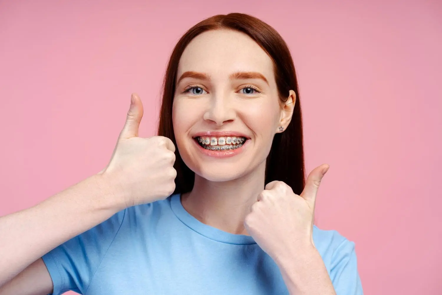 Smiling patient with traditional metal braces for fix Crossbite Treatment, giving thumbs up at Limestone Hills Orthodontics in Austin, TX.
