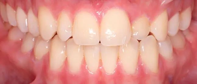 Showing clean, straight teeth and healthy gums after crossbite correction at Limestone Hills Orthodontics in Austin, TX.
