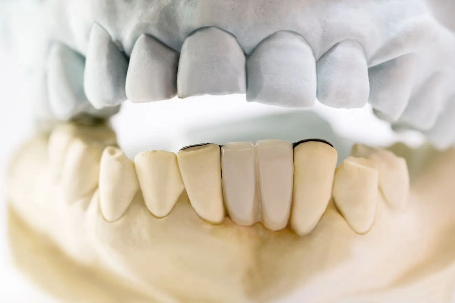 Dental models with crowns or veneers used for TMJ guard demos at Limestone Hills Orthodontics in Austin, TX.