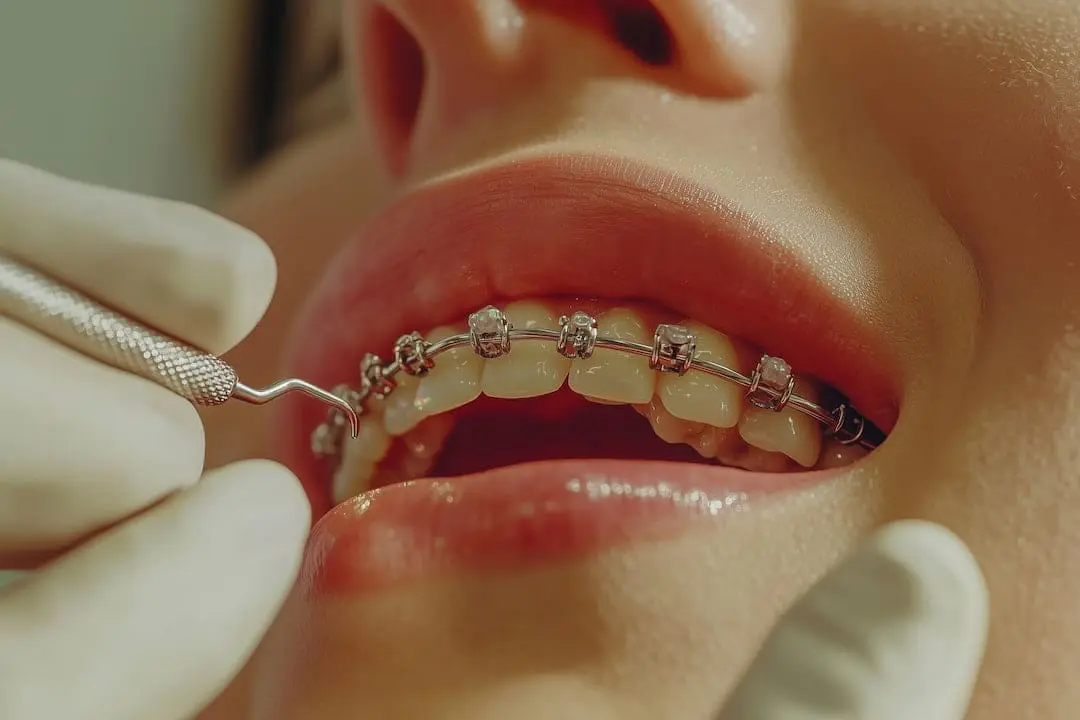 A gloved hand examines braces on a patient, showing Limestone Hills Orthodontics' high standards in Austin, TX.