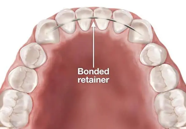 Upper teeth diagram with bonded retainer behind front teeth, arrow marking placement at Limestone Hills Orthodontics in Austin, TX.